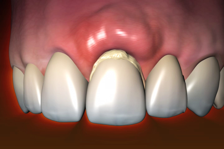  5 Symptoms of The Common Dental Problems